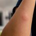 How to Get Rid of Mosquito Bites ASAP