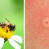 Identifying Bug Bites: How to Figure Out What Bit You